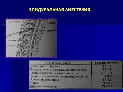 Эпидуральный анестетик