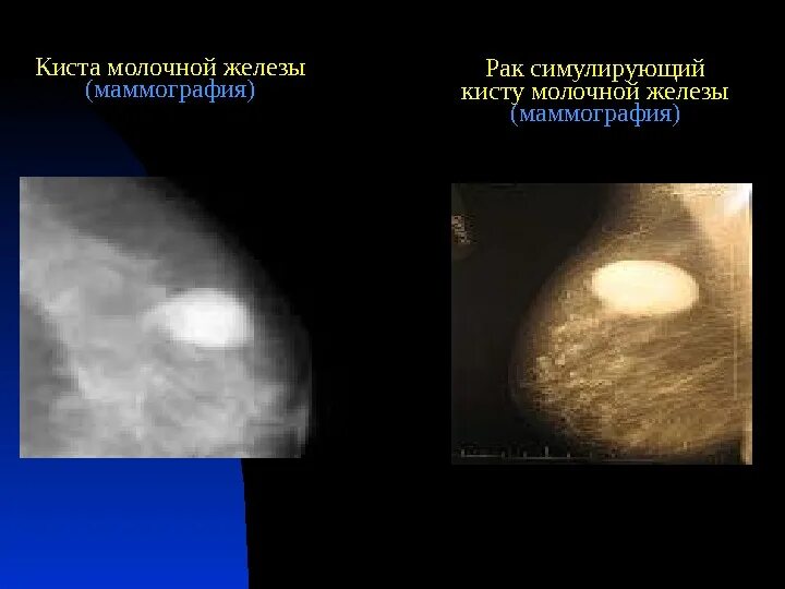 Как отличить кисту. Кистозная мастопатия маммография. Кисты молочных желез на маммограмме. Галактоцеле на маммографии. Фиброаденома молочной на маммографии.