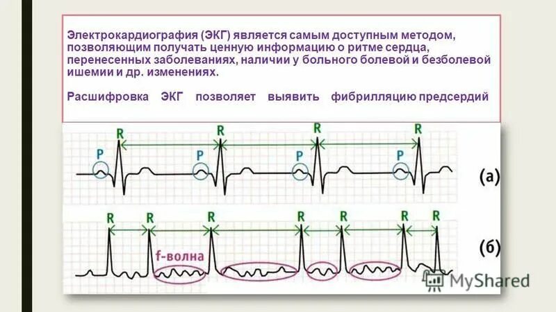 Нарушения ритма сердца тесты с ответами. Нарушения ритма сердца тесты с ответами