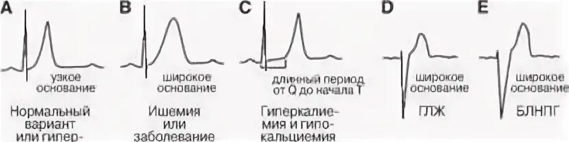 Конкордантный подъем сегмента. Синдром ранней реполяризации. экг деполяризация и реполяризация. конкордантное повышение сегмента st. деполяризация желудочков.