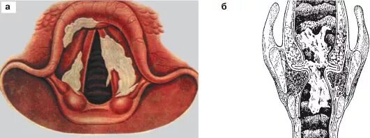 Лейкоплакия слизистой гортани. Дифтеритическое воспаление зева.