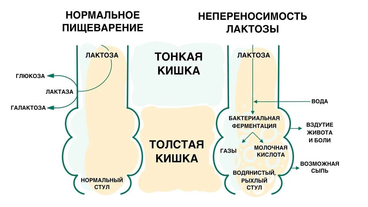 Неперенсоимостьлктозы. Непереносимость лактозы. Непереносимость лактозы биохимия. Непереваривание лактозы симптомы. Непереносимость лактозы.