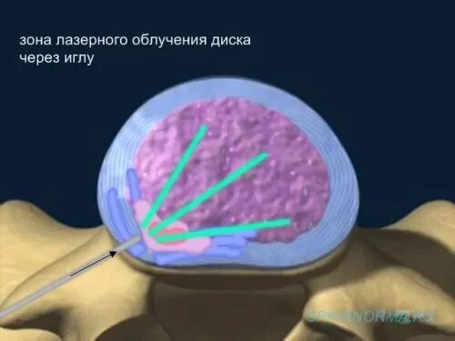 Операции лазером грыжа