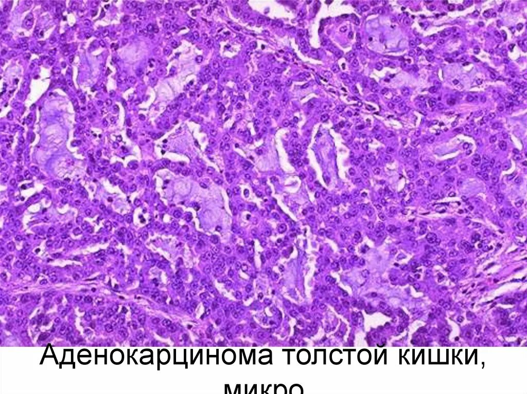 Что значит умеренно дифференцированная аденокарцинома. Аденокарцинома толстого кишечника гистология. аденокарцинома кишечника гистология. аденокарцинома кишки гистология. аденокарцинома толстой кишки патанатомия.