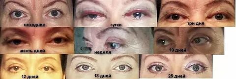 За сколько уходят отеки