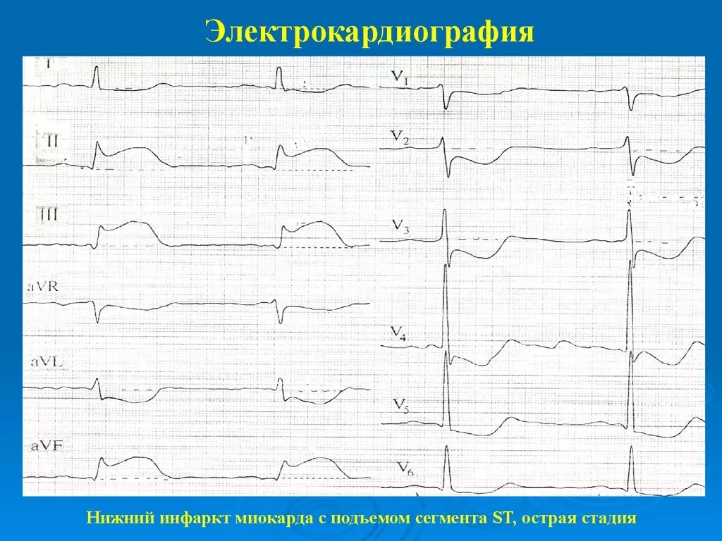 Сегмент St острый инфаркт миокарда. ЭКГ инфаркт миокарда с подъемом St переднеперегородочный. Инфаркт с подъемом сегмента St ЭКГ. Подъем сегмента St на ЭКГ v1 v2.