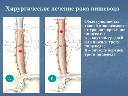 Лечение пищевода
