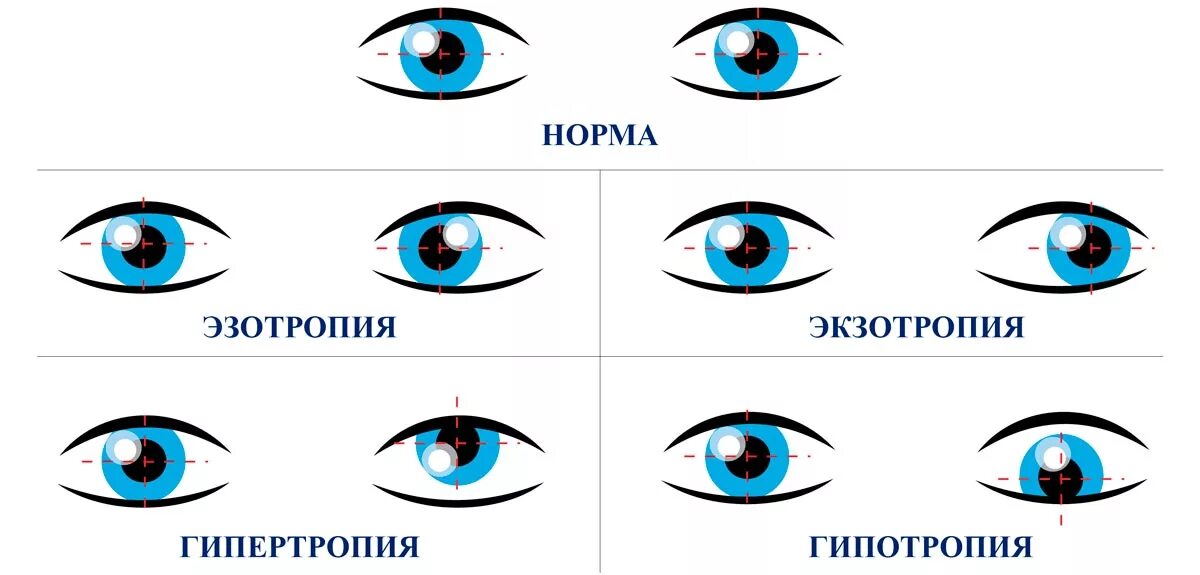 Косит глаз причины. Гимнастика для глаз при расходящемся косоглазии у детей. Косоглазие схема глаза. Гимнастика для глаз косоглазие у детей. Упражнения для глаз сходящееся косоглазие.