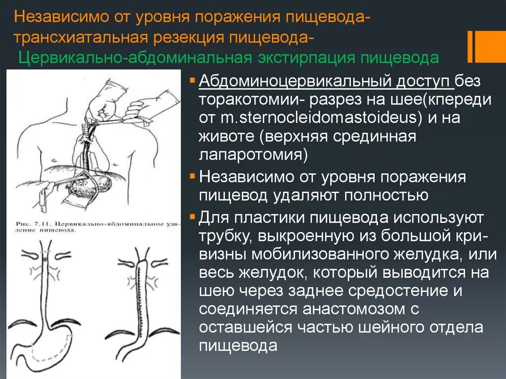 Методы лечения пищевода.  Операция Льюиса -экстирпация пищевода. Цервикально абдоминальная экстирпация пищевода. Экстирпация пищевода с пластикой желудочной трубкой. Трансхиатальная субтотальная резекция пищевода.