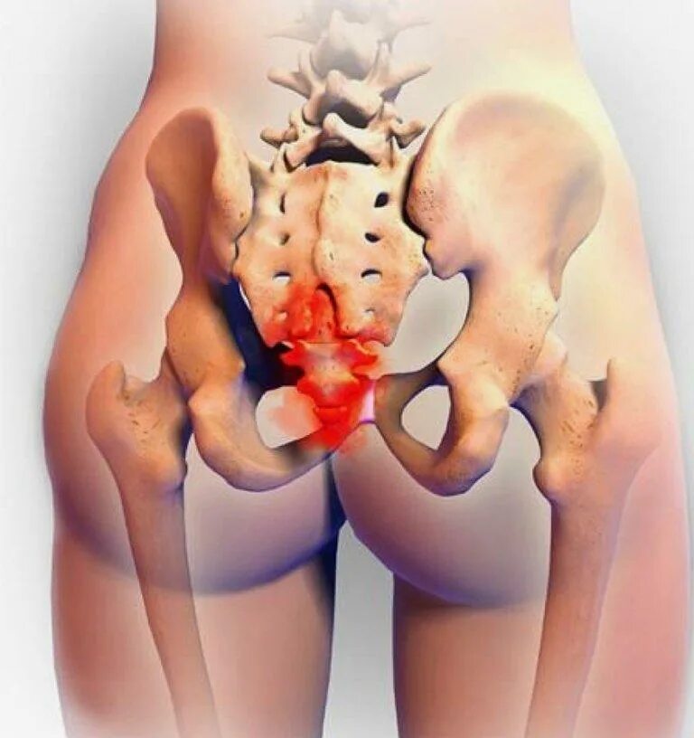 Позвоночник копчик болит. Грыжа копчика позвоночника. Крестцово поясничный отдел кобчик. Хруст в копчике. Крестцово поясничный отдел кобчик.