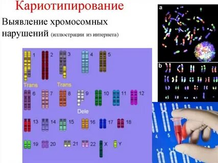 Кариотип цитогенетическим методом