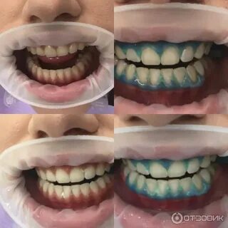 Отбеливание капой отзывы