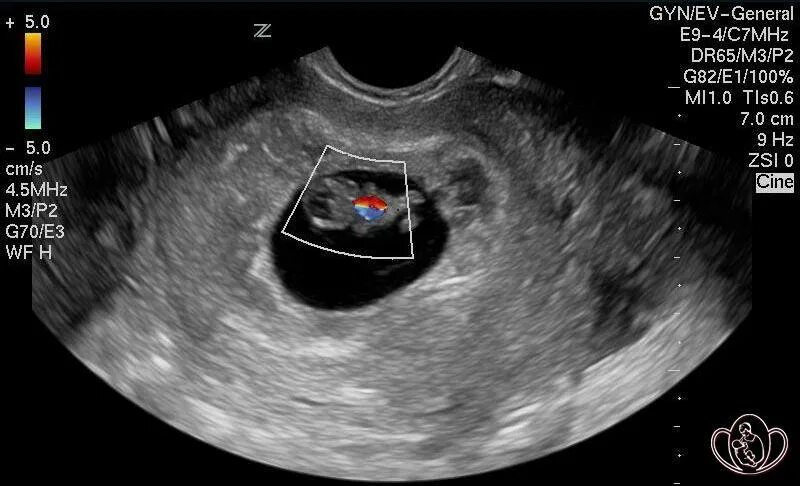 В течении 7 недель 8. Эмбрион на 8 неделе беременности УЗИ. Фото эмбриона на 8 неделе беременности на УЗИ. Эмбрион на 7 неделе беременности УЗИ. УЗИ плода 7-8 недель беременности.