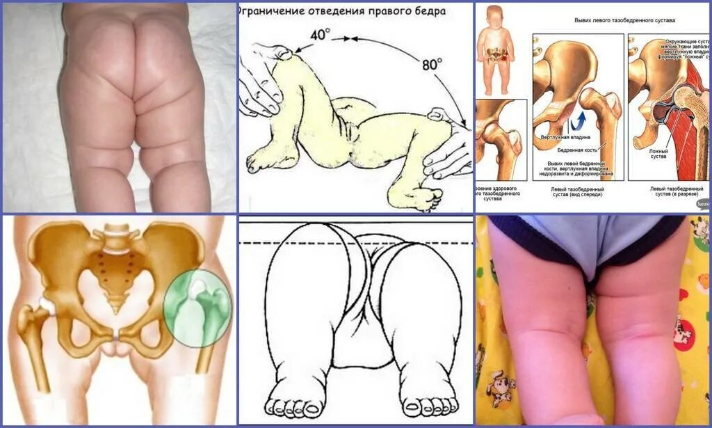 Дисплазия сустава у новорожденного лечение. Дисплазия тазобедренных суставов у ребенка 1 год. Дисплазия тазобедренных суставов симптомы. Дисплазия тазобедренных суставов у новорожденных 2 б.