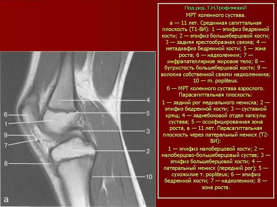 Связки коленного сустава анатомия кт. Рентген коленного сустава зона роста. Реконверсия костного мозга коленного сустава. Передний мыщелок большеберцовой кости.