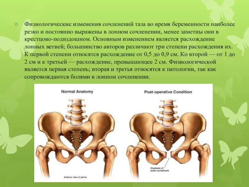 Расхождение костей таза. Расхождение костей таза при беременности. Нерасхождение иазрвых костей. Расширение таза мужчин