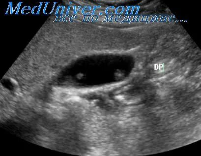 Рак желчного пузыря на узи как выглядит Gallbladder cancer and healthy gallbladder, illustration Stock Image F027/56