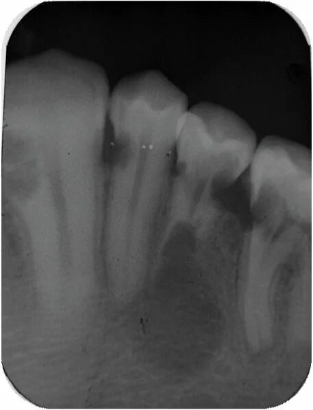 Цервикальная резорбция корня. Резорбция корня зуба на рентгене. Наружная резорбция корня зуба.
