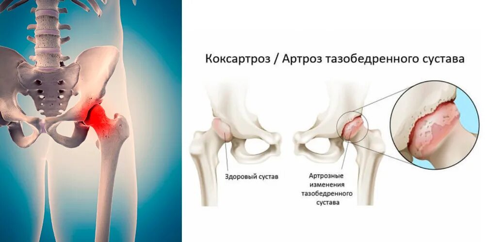 Артрит артроз тазобедренных суставов. Коксартроз эндопротезирование тазобедренного сустава. Коксартроз тазобедренного симптомы. Посттравматический артроз тазобедренного сустава рентген. Коксо артроз бедренного сустава.