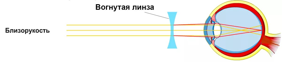 Линзы для зрения дальнозоркость. Миопия и гиперметропия линзы. Рассеивающая линза дальнозоркость или близорукость. Линзы для глаз для зрения -5 миопия. Линзы для близоруких рассеивающие.