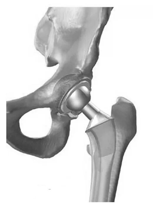 Замена тазобедренного сустава как проходит операция. Перелом шейки бедра эндопротезирование. Эндопротезирование головки бедренной кости. Эндопротез шейки бедра. Гемиартропластика тазобедренного сустава.