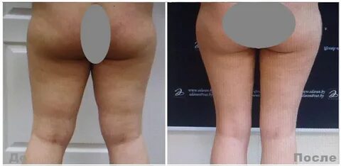 Липосакция ног до и после