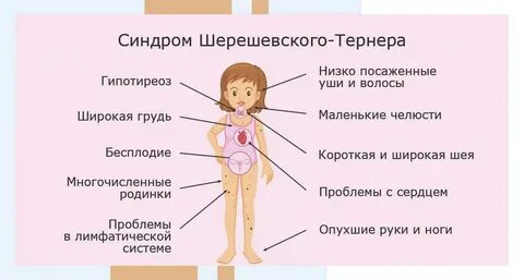 Симптомы шерешевского тернера