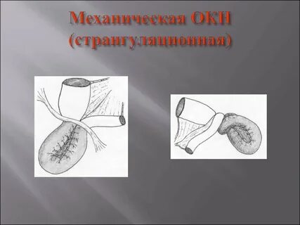 Острая странгуляционная непроходимость