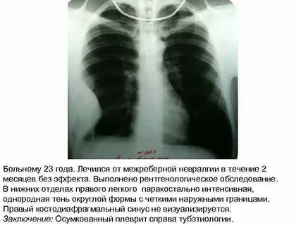 Невралгия рентген