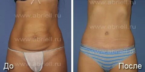 Валик после кесарева как убрать внизу живота