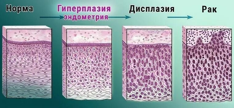 Изменения эпителия матки. Атипическая гиперплазия железистого эпителия. Железистая гиперплазия гистология. Дисплазия шейки матки аномальная. Метаплазия цервикального эпителия.