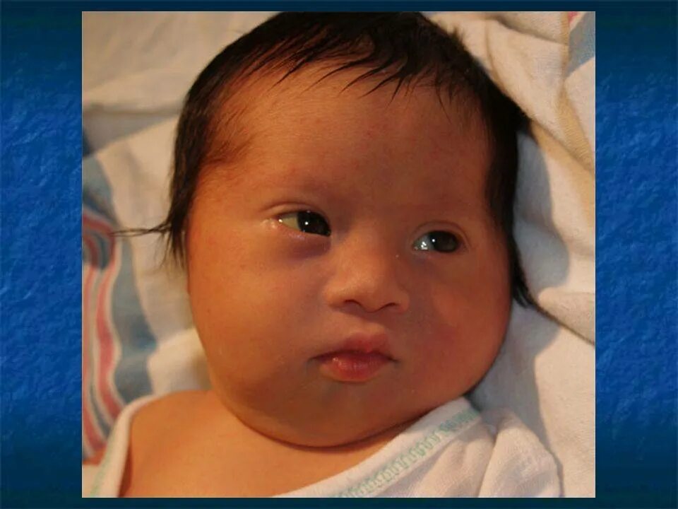 Рождаются ли говорящие дети. Эпикантус синдром Дауна. Эпикант, монголоидный разрез глаз. Дети с узкими глазами. Разрез глаз у новорожденных.