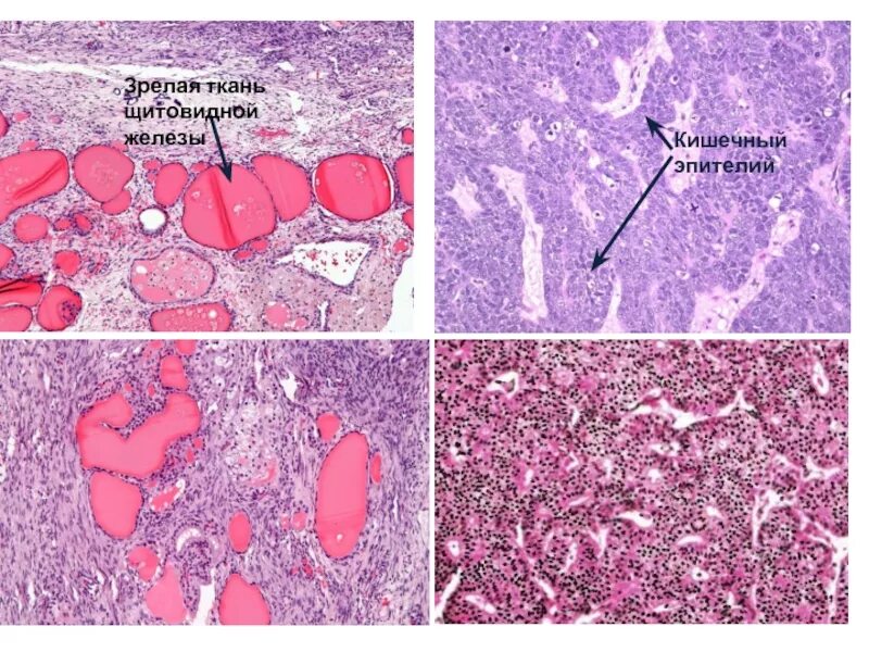 Изменение тканей щитовидной железы. Ткань щитовидной железы. Эпителиальная ткань щитовидной железы. Железистый эпителий щитовидной железы. Тиреоидный эпителий щитовидной железы что это.