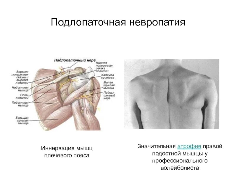 Плексит плечевого сплетения клиника. Защемление нерва плечевого сустава симптомы и лечение. Подлопаточный нерв иннервирует. Защемление нерва плечевого сустава симптомы и лечение. Защемление в плечевом суставе.