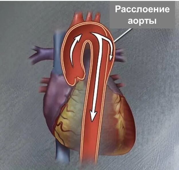 Аневризма сердца что это такое симптомы. Острое расслоение аорты. Расслаивающейся аневризмы аорты. Отслоение стенки аорты сердца. Расслоение аневризмы аорты 2 Тип.