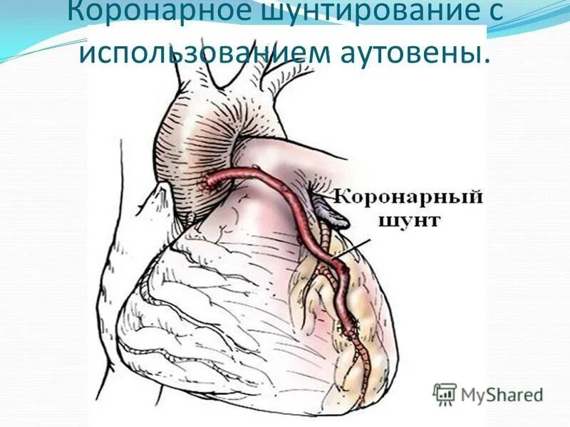 Почему делают шунтирование. Маммарно коронарное шунтирование. маммарокоронарное шунтирование схема. шунтирование коронарных артерий сердца. аорта коронарное шунтирование.