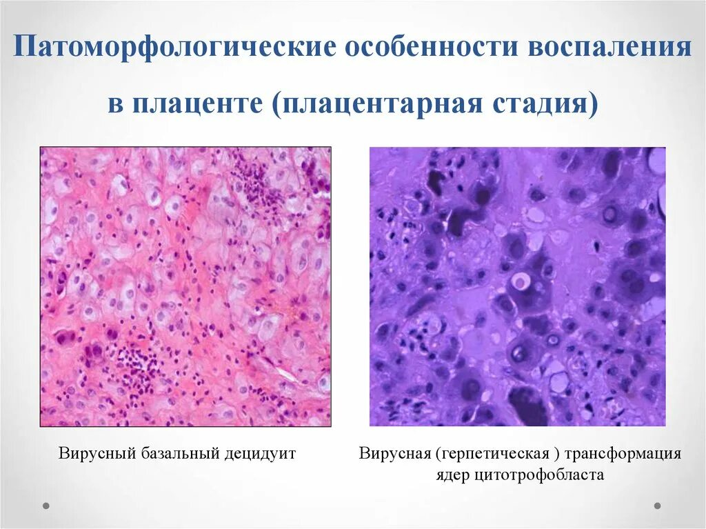 Очаговый гнойно. Очаговый децидуит гистология. Патология плаценты микропрепараты. Серозный очаговый базальный децидуит. Хориодецидуит гистология.