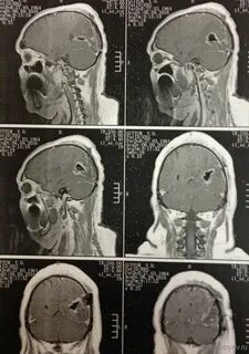 Астроцитома головного мозга прогноз после операции