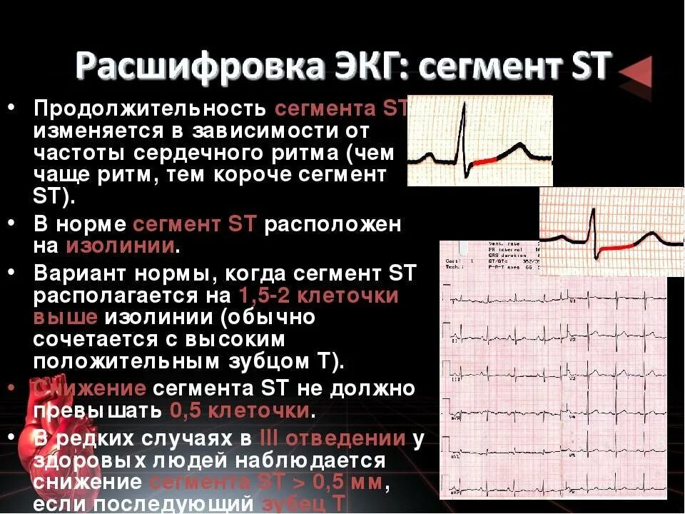 ЭКГ сердца QRS норма. Патология комплекса QRS на ЭКГ. ЭКГ 2 отведение норма. ЭКГ зубец р в норме и при патологии. Мв на экг