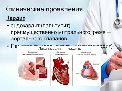 Острый ревматический кардит