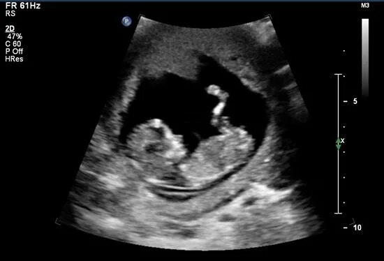 Узи плода 13 недель. Снимки УЗИ на 13 неделе беременности. Ребенок на 13 неделе беременности УЗИ. УЗИ плода 13 недель беременности пол ребенка. Плод на 12-13 неделе беременности на УЗИ.