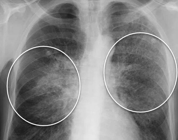 Посттуберкулезный пневмосклероз. Хламидийная пневмония рентген. Токсический пневмосклероз. Плутониевый пневмосклероз. Ковид восстановление легких