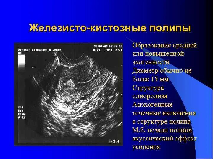 Полип после медикаментозного прерывания. Железисто-фиброзный эндометриальный полип. Аденоматозные полип эндометрия УЗИ. Железистый полип эндометрия на УЗИ.