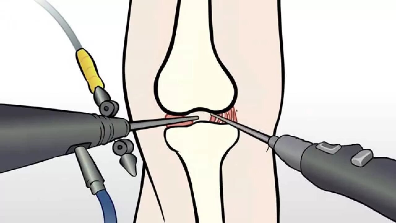 Разрыв мениска артроскопия. Артроскопия дебридмент. Артроскопическая санация коленного сустава. Санационная артроскопия.