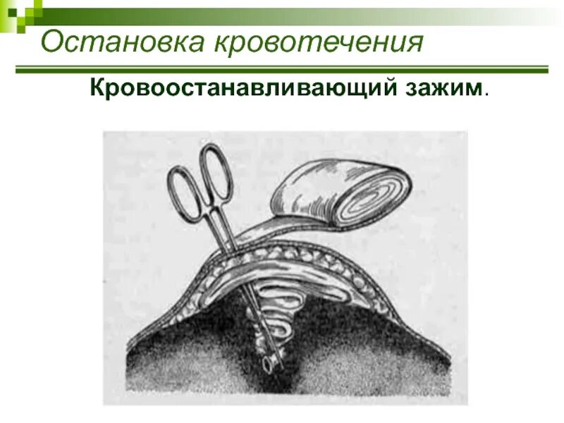 Тампонада раны при артериальном кровотечении