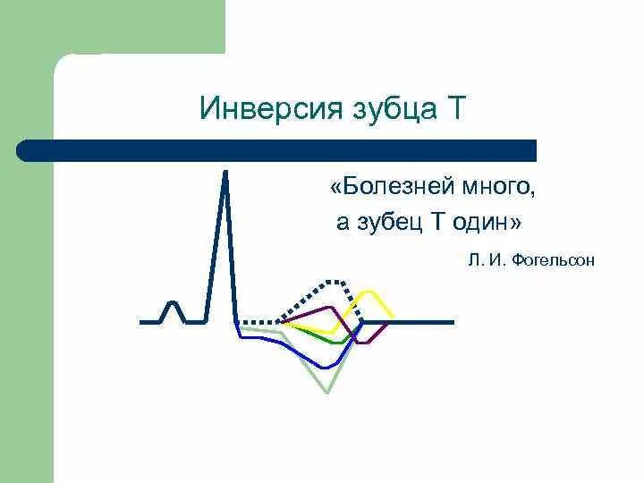 Инверсия зубца т. Экг инверсия зубца т в v2. инверсия зубца т в v1-v4. инверсия зубца т на экг в 3 отведении. сглаженный зубец t на экг.