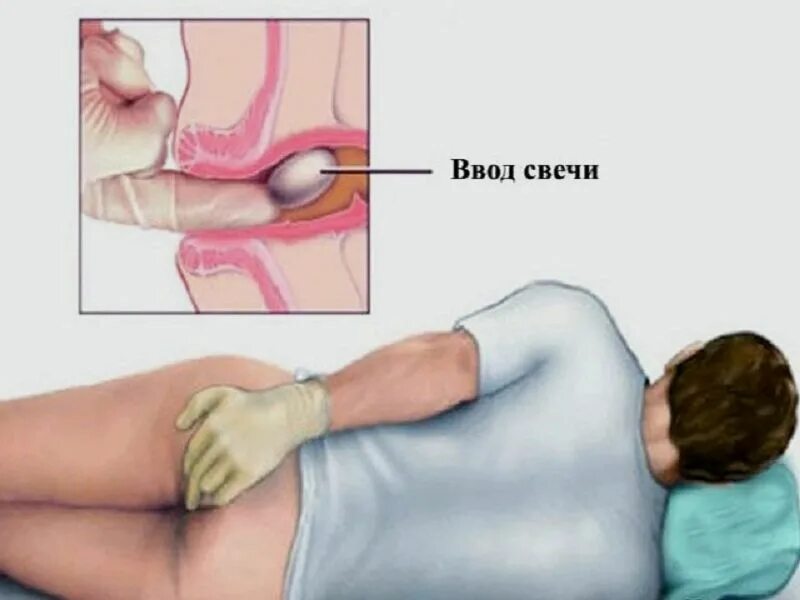Как правильно вставлять свечи в прямую кишку. Свечка в попе. медицинская свечка в попе. ректально это как. ректальные свечи в попу.