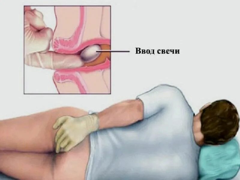 Как правильно вставлять ректальные. Ректальные свечи. Что такое ректальное Введение свечей. Свечи от геморроя. Пальцевое исследование прямой кишки.