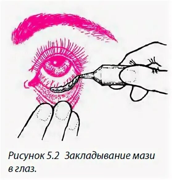 Алгоритм закладывания в глаза. Закладывание мази в глаза. мазь в конъюнктивальный мешок. закладывание в конъюнктивальный мешок. закладывание мази в конъюнктивальный мешок.