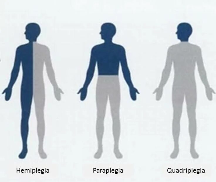 Гемипарез монопарез парапарез. Левосторонний спастический гемипарез. ДЦП правосторонний гемипарез. Гемипарез руки